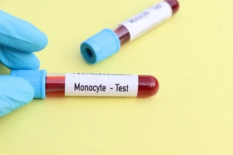Monocyte test, blood sample to analyze in the laboratory Stockfoto's