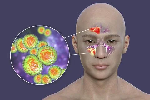 Moraxella catarrhalis bacteria as a cause of sinusitis, 3D illustration Stockillustratie