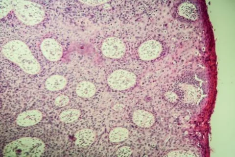 Morbus Bowen Stock Photos