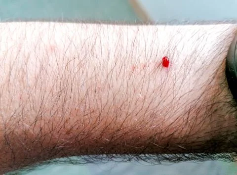 Mosquito Bite Bleeding Stock Photos