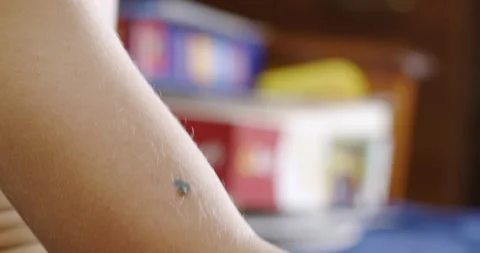 A mosquito bite on a child's hand Stockbeeldmateriaal 196938887