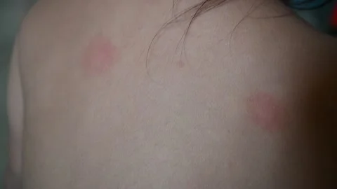 Mosquito bite mark Stock Footage 291404926