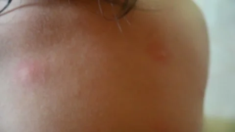 Mosquito bite mark Stock Footage 291404930