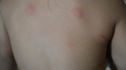 Mosquito bite mark Stock Footage 291404961
