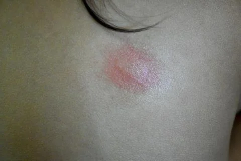 Mosquito bite mark Foto stock