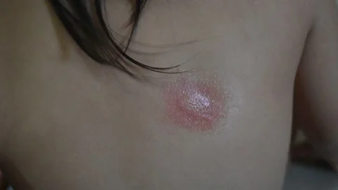 Mosquito bite marks Stock Footage 295780342