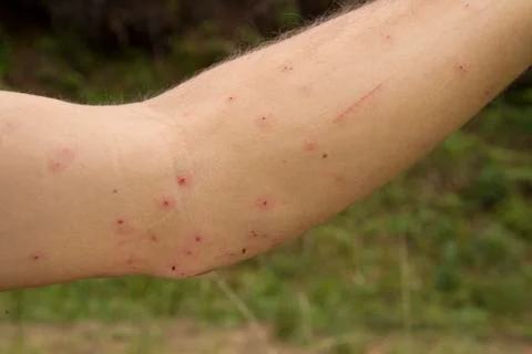 Mosquito bite Stock Photos