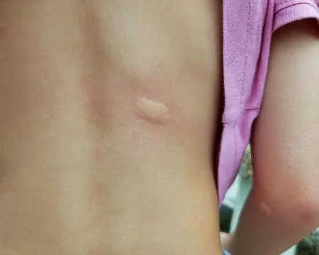 Mosquito bites on a child's back. 写真素材