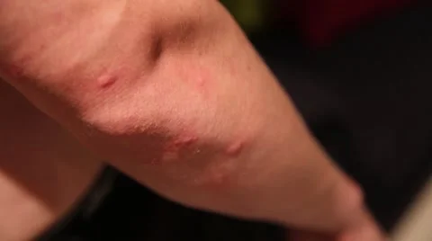 Mosquito bites Video stock 56583323