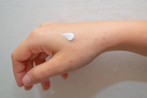 Mosquito bites on the hand Stock Photos