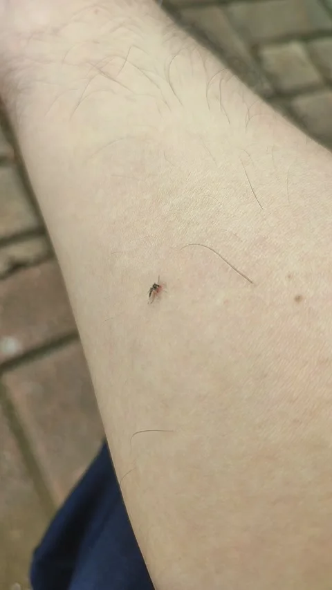 Mosquito Biting Human Skin Close-Up Video stock 331304366