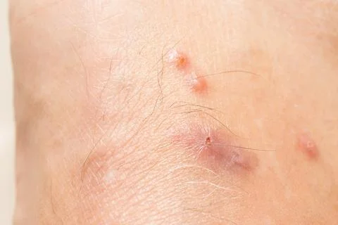 Mosquitos Bites that appear to be slightly infected Stock Photos