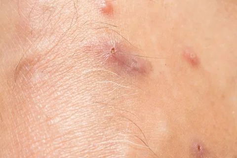 Mosquitos Bites that appear to be slightly infected Stock Photos