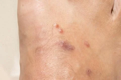 Mosquitos Bites that appear to be slightly infected Stock Photos