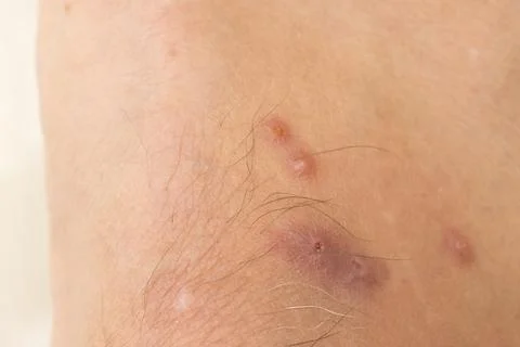 Mosquitos Bites that appear to be slightly infected Stock Photos