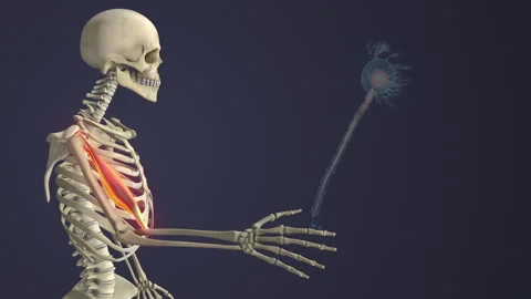 Motor Neuron Disease Causing Skeletal Muscle Weakness Stock Footage 325711513