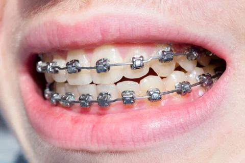 Mouth with bracket Stock Photos