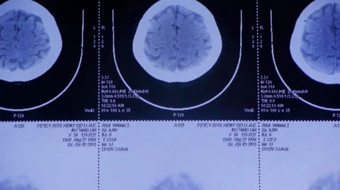 moving head pet cT scan,skull brain X-ra... | Stock Video | Pond5