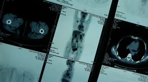 Moving human orage pet-ct scan,medical X-ray,Cancer metastasis. Stock Footage 22956962