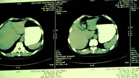Moving liver pet-ct scan,human organ X-ray radiography. Stock Footage 22952389