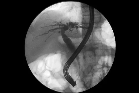 MR cholangiography Stock Illustration