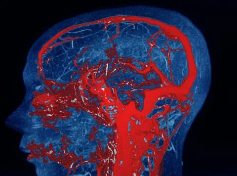 MRA AND MRV OF BRAIN Finding:Bilateral territorial muscles to the cortex and  Stock Photos