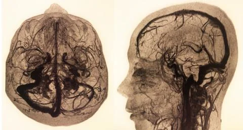 MRA AND MRV OF BRAIN Finding:Bilateral territorial muscles to the cortex and  Stock Photos