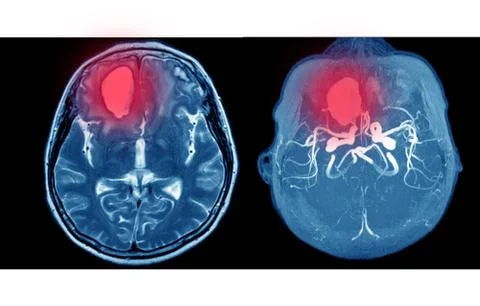 MRA AND MRV OF BRAIN Multiple acute intracranial hemorrhage at bilateral fron Stock Photos