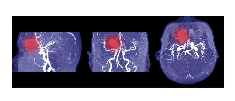 MRA AND MRV OF BRAIN Multiple acute intracranial hemorrhage at bilateral fron Stock Photos