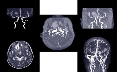MRA AND MRV OF BRAIN:, presented with intracranial hemorrhage.This study was  Stock Photos