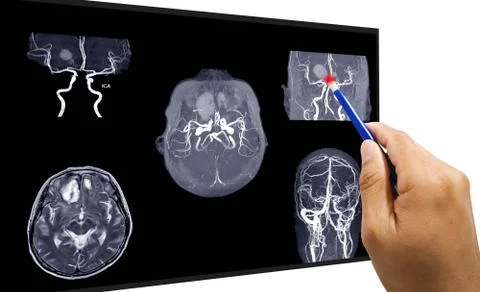 MRA AND MRV OF BRAIN:, presented with intracranial hemorrhage.This study was  Stock Photos