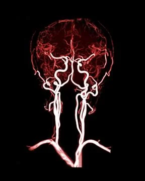 MRA brain Coronal 3D MIP veiw showing Common carotid artery and cerebral arte Stock Illustration