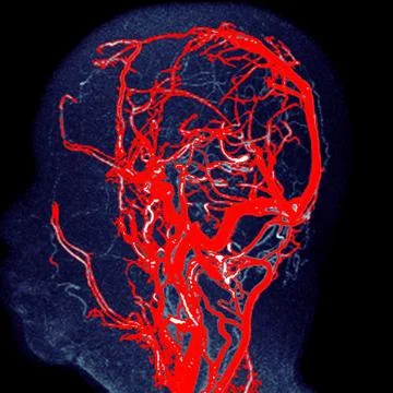 MRA brain Coronal 3D Sagittal MIP view showing Common carotid artery and cere Stock Photos