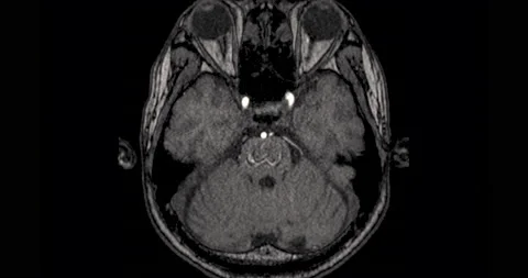 MRA Brain Stock Footage 222933616