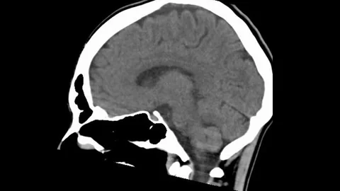 MRI Analysis of the Human Brain: Detailed View of Gray and White Matter Stock Footage 316624488