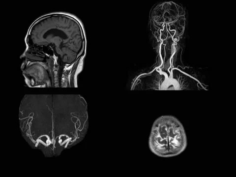 MRI and MRA Brain 01 Stock Footage 158902008