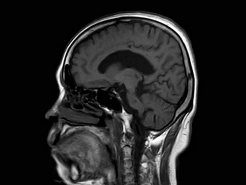 MRI and MRA Brain 02 Stock Footage 158901990
