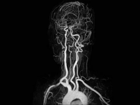 MRI and MRA Brain 04 Stock Footage 158901997