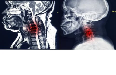 MRI and X-ray image of cervical spine, neck x-ray image Cervical Spondylosis Stock Photos