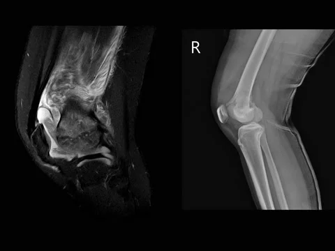MRI and X-ray Knee joint. Vidéo 158902060
