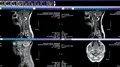 MRI arthritic cervical spine Video HD