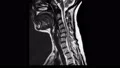 MRI arthritic disc protrusion neck cervical spine Video HD