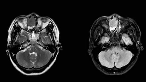 MRI Brain 01 Stock Footage 158902080