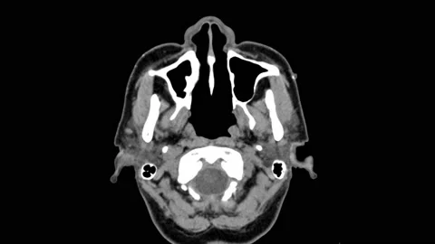 MRI Brain 02 Stock Footage 158902081