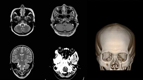 MRI Brain 04 Stock Footage 158902214