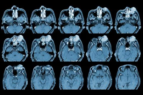 MRI OF BRAIN AND ORBIT Finding A well-defined, cystic lesion with internal pa Stock Photos