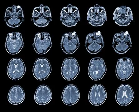 MRI OF BRAIN AND ORBIT Finding A well-defined, cystic lesion with internal pa Stock Photos