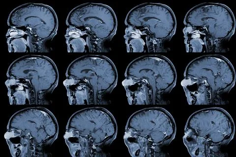 MRI OF BRAIN AND ORBIT Finding A well-defined, cystic lesion with internal pa Stock Photos