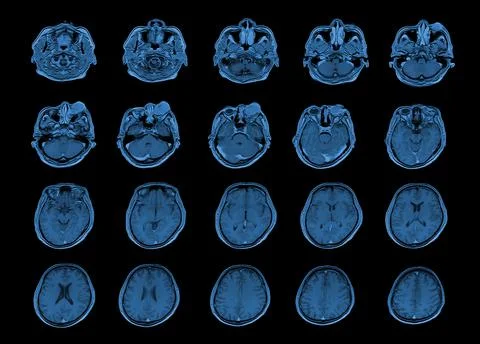 MRI OF BRAIN AND ORBIT Finding A well-defined, cystic lesion with internal pa Stock Photos