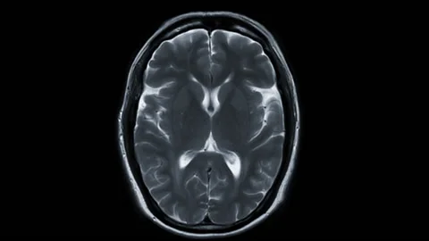 Mri brain ax t2w . Video stock 152724742